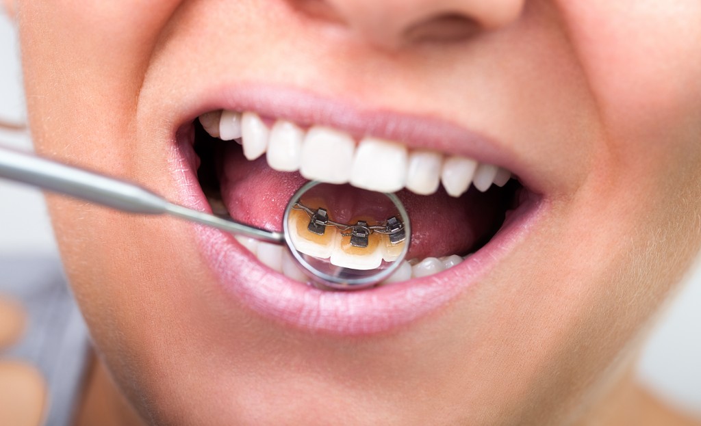 Aparatul dentar invizibil  – varianta perfectă pentru adulți