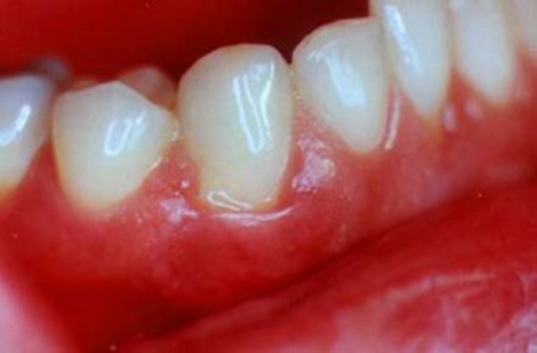 Gingivita – afectiunea care poate duce la pierderea dintilor