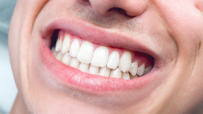 30% dintre tineri afectati de eroziune dentara. Cauze si simptome