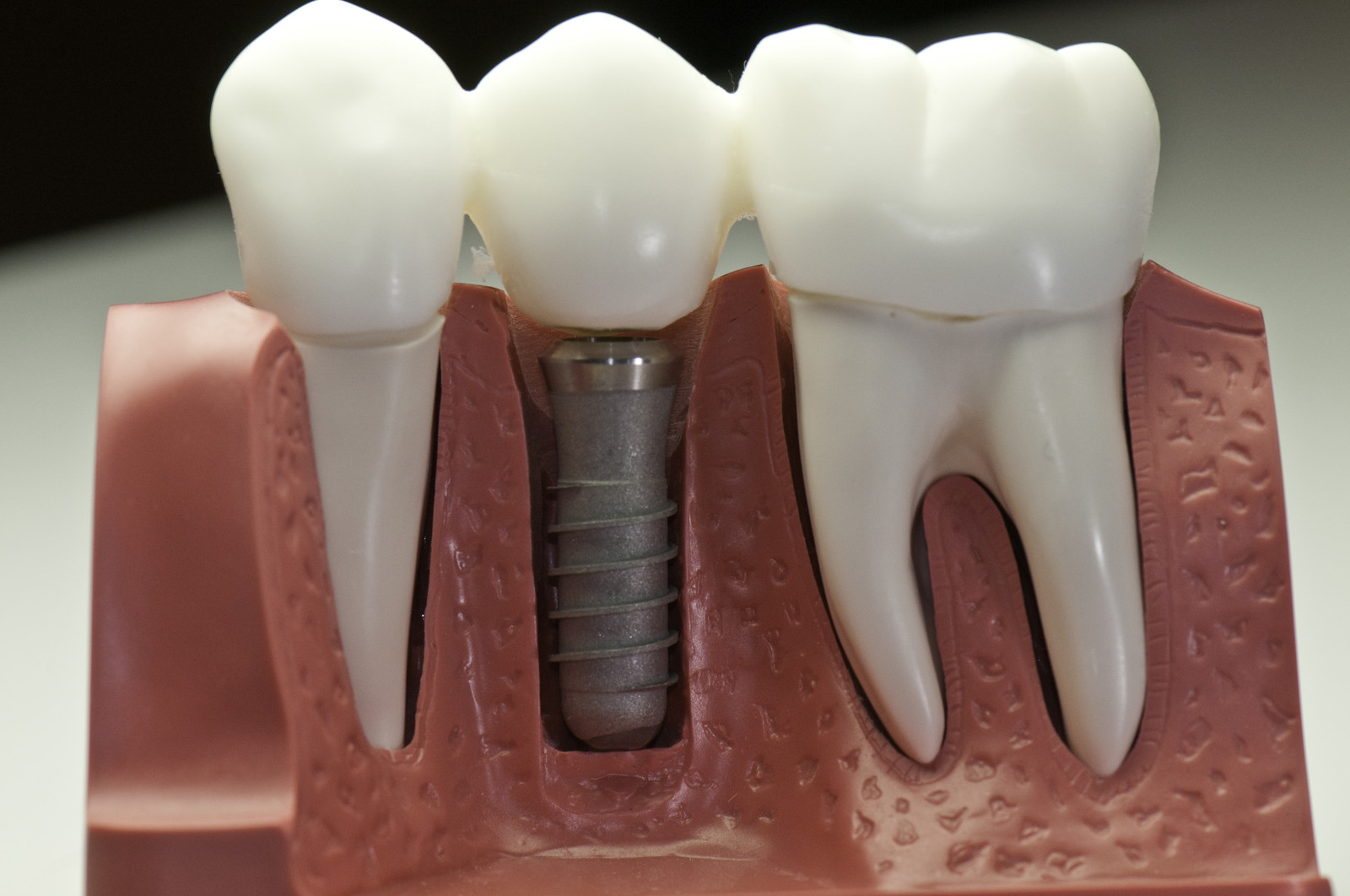 De ce ai nevoie de implanturi dentare